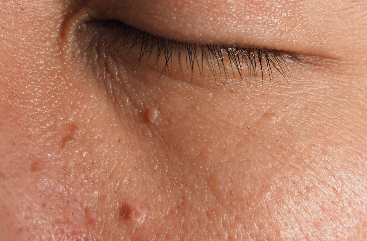 Skin Lesion Removal In Birmingham MediZen