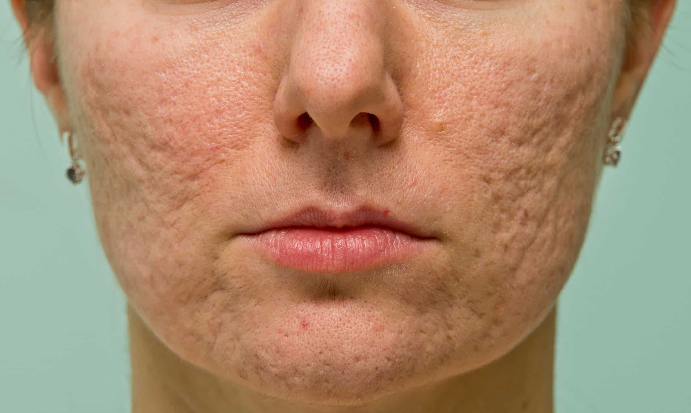 Atrophic acne scars