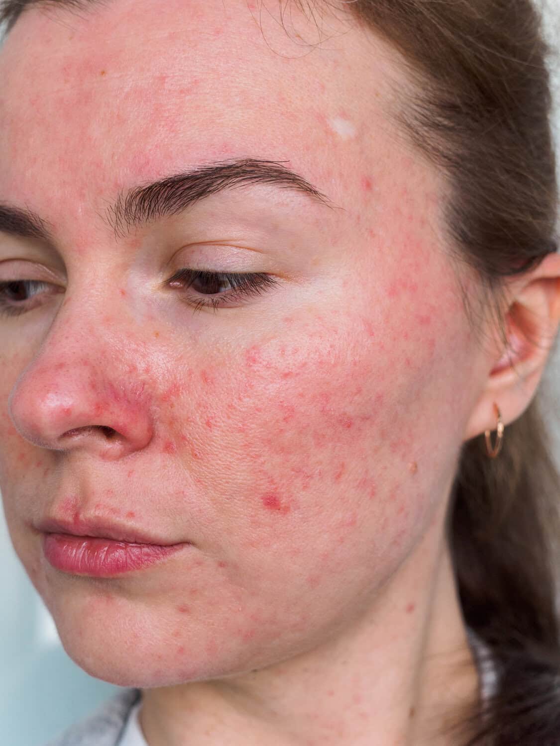 Facial & nose thread veins