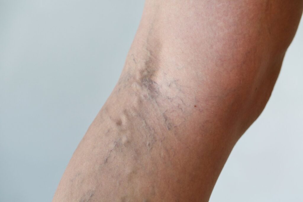 Varicose veins (true)