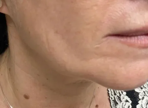 Before Endolift: side view of a woman's jawline and jowls showing laxity.