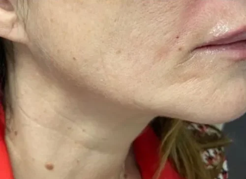 After Endolift: the same jawline appearing firmer and more defined.