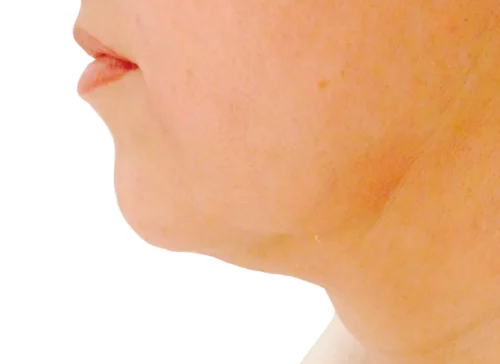 Before Endolift: profile showing fullness under the chin.