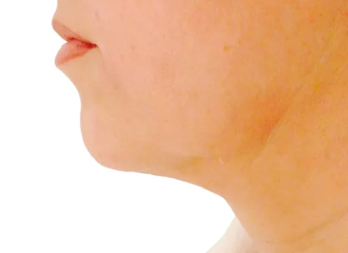 After Endolift: profile with a slimmer, tighter contour under the chin.
