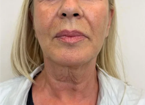 Before Endolift: front view of the lower face and neck showing loose skin and neck lines.