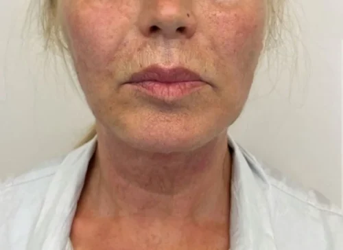 After Endolift: the same neck and jawline looking smoother and firmer.