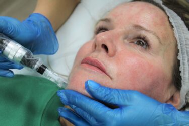 A woman receiving a micro-needling treatment on her face at MediZen clinic.