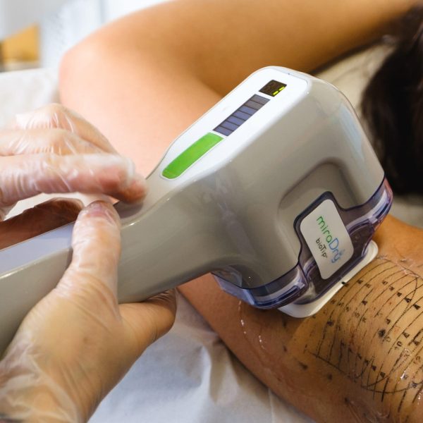 MiraDry treatment being performed on a patient's underarm.