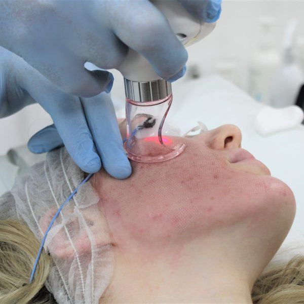 A medical professional performs a skin treatment using a specialised device on a patient.