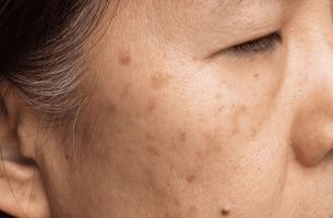 Close-up of facial pigmentation and sun spots on a woman's cheek.