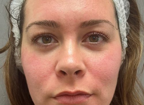 Close-up of a woman's face during a facial treatment at MediZen clinic.