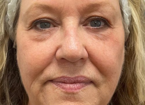 Close-up of a middle-aged woman's face showing skin treatment results.
