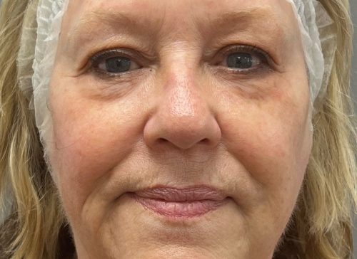 Close-up of a mature woman's face with visible signs of aging.