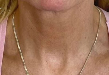 Close-up of a woman's neck showing skin texture before Polynucleotides treatment.