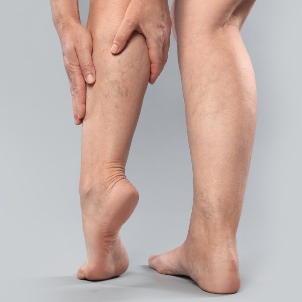 Close-up of a person's legs showing varicose veins on the calves and thighs.