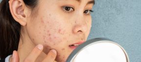 Young woman examining her acne-prone skin in a mirror.